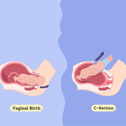 C-Section vs Vaginal Birth